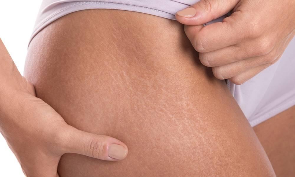 Természetes stria elleni krém