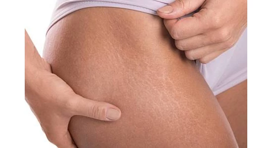 A hatékony stria elleni krémek kiválasztása terhes nők és újdonsült anyák számára